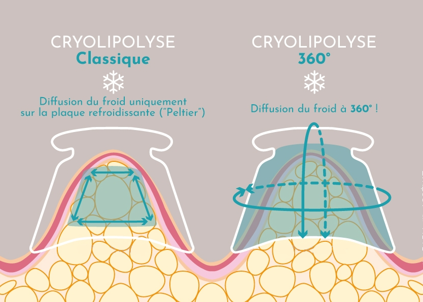 Cryolipolyse